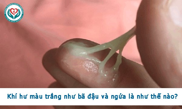 Khí hư màu trắng như bã đậu và ngứa là như thế nào?