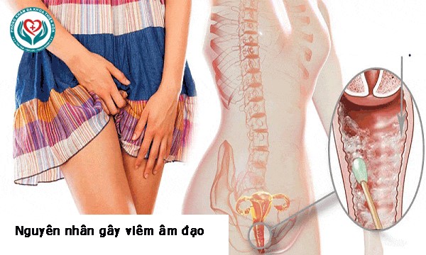 Nguyên nhân bị viêm nhiễm âm đạo