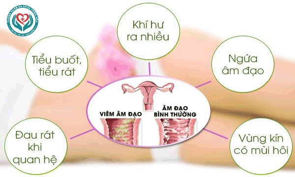 Triệu chứng thường gặp khi bị viêm âm đạo