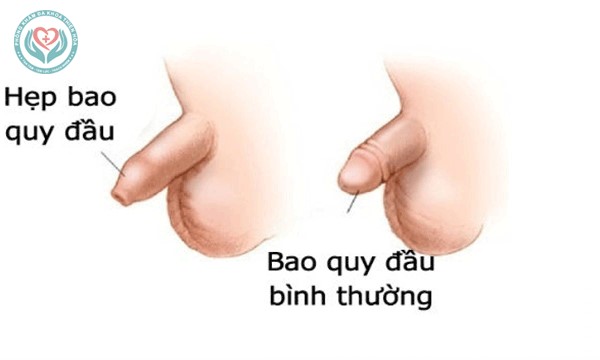 Thế nào là hẹp bao quy đầu?