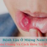 Bệnh lậu ở miệng nam giới - Triệu chứng và cách điều trị hiệu quả