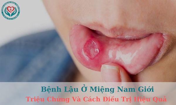 Bệnh lậu ở miệng nam giới - Triệu chứng và cách điều trị hiệu quả