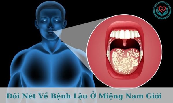 Đôi nét về bệnh lậu ở miệng nam giới