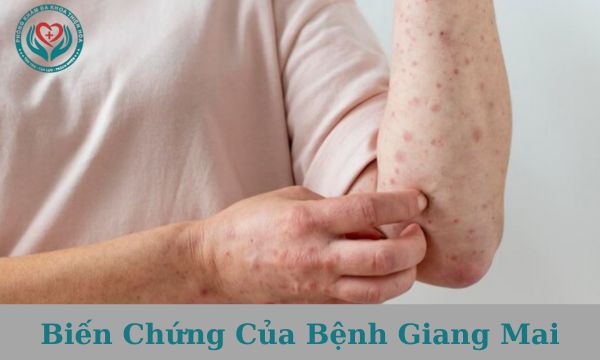 Biến chứng của bệnh giang mai gồm những gì